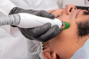 épilation laser